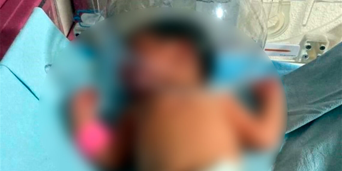Ante falta de equipo, hospital del IMSS salva la vida a un recién nacido con una botella