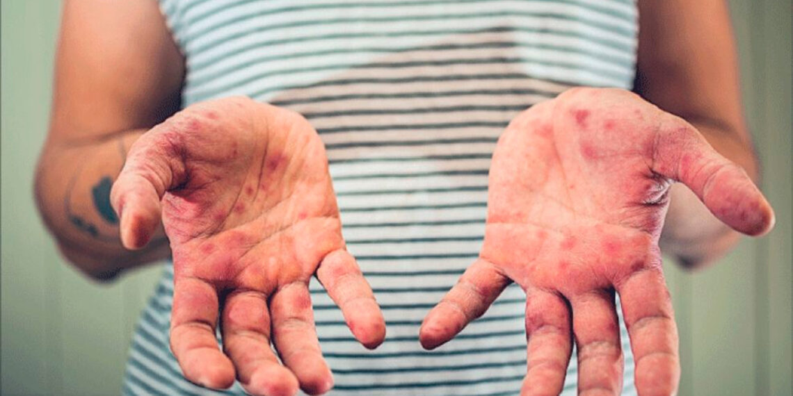 Confirman segundo caso de sarampión en Guanajuato